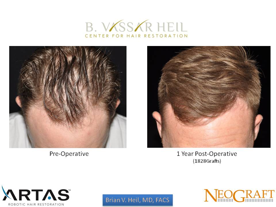 Hair Restoration Before and After | Premier Plastic Surgery