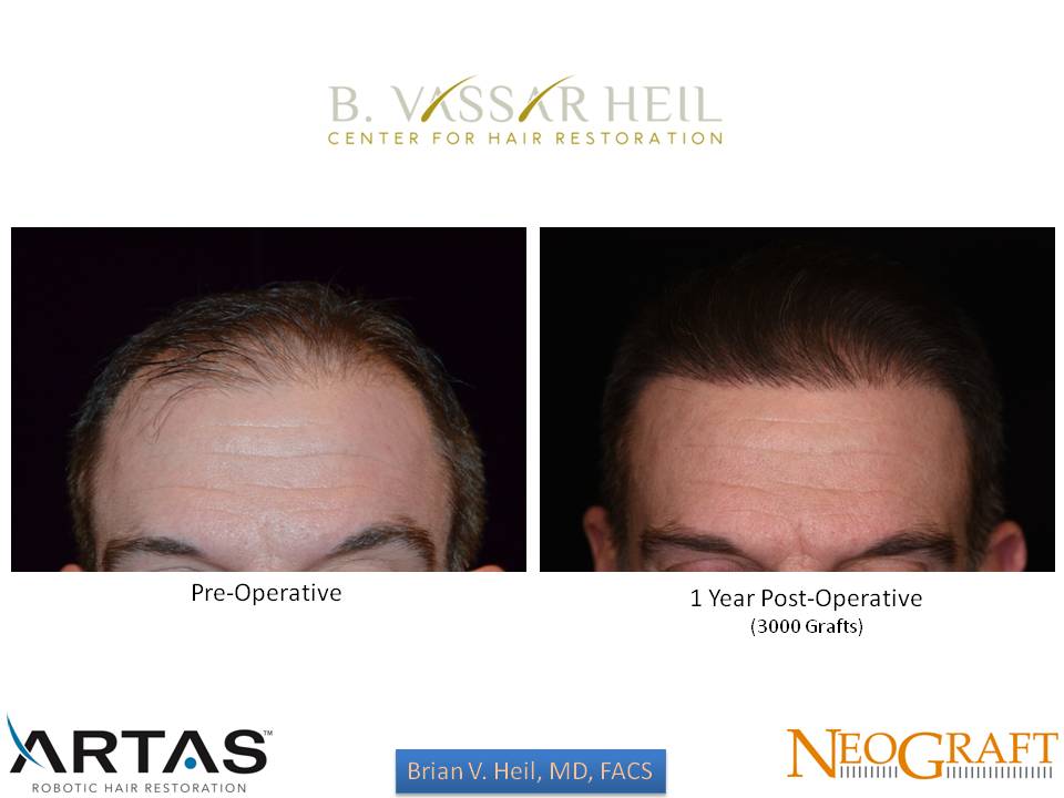 Hair Restoration Before and After | Premier Plastic Surgery