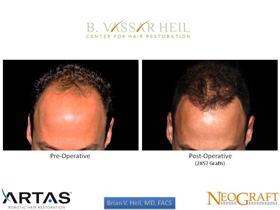 Hair Restoration Before and After | Premier Plastic Surgery