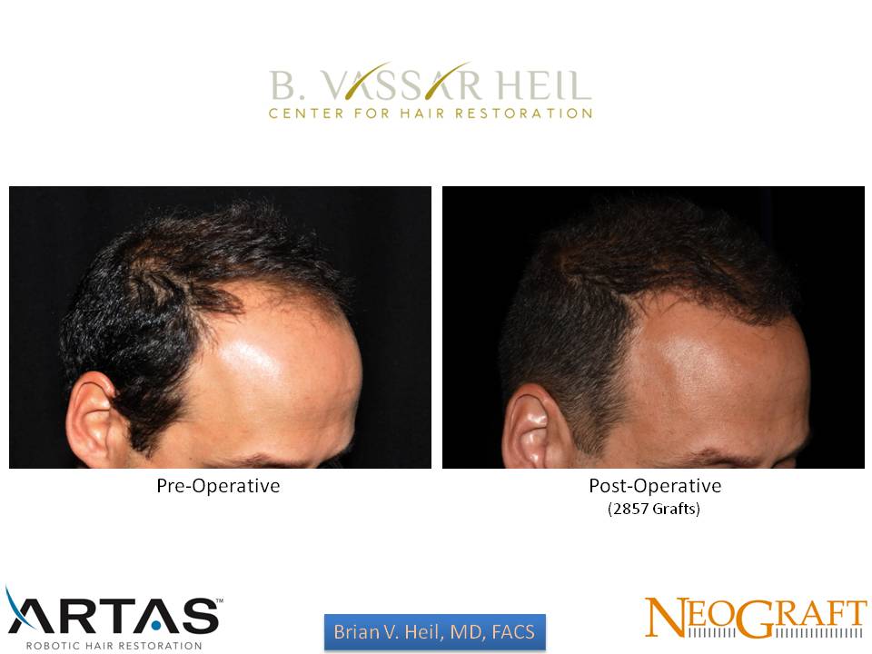 Hair Restoration Before and After | Premier Plastic Surgery