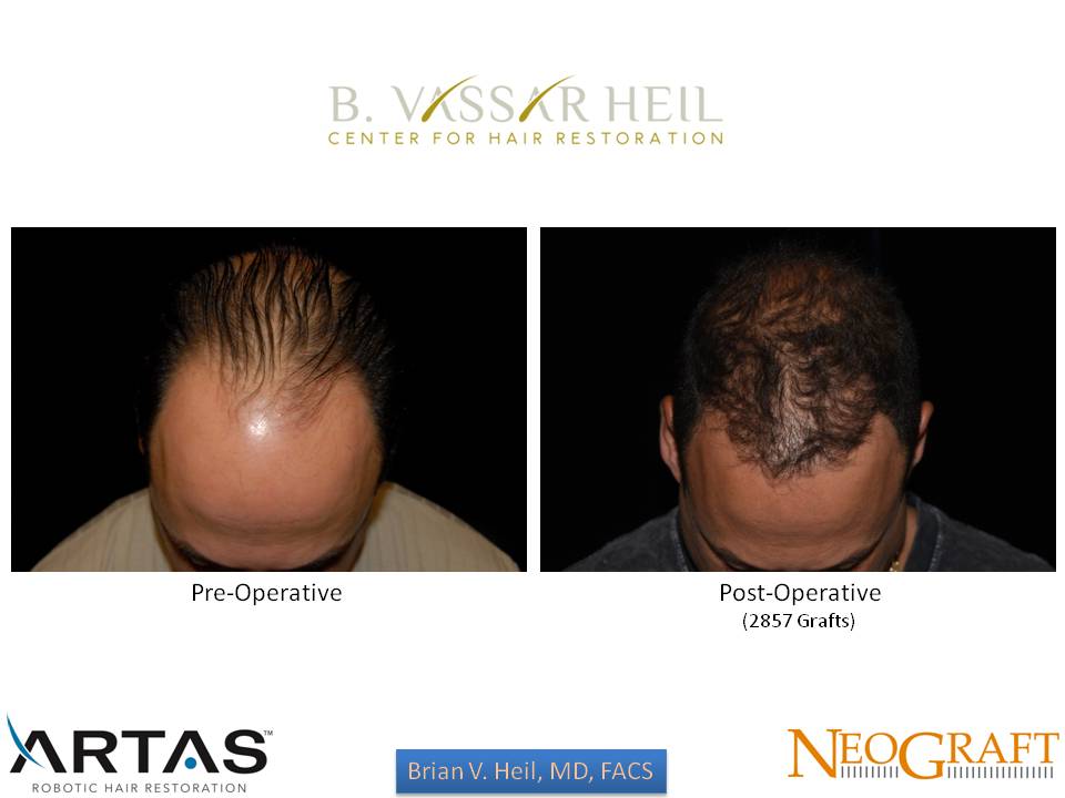 Hair Restoration Before and After | Premier Plastic Surgery