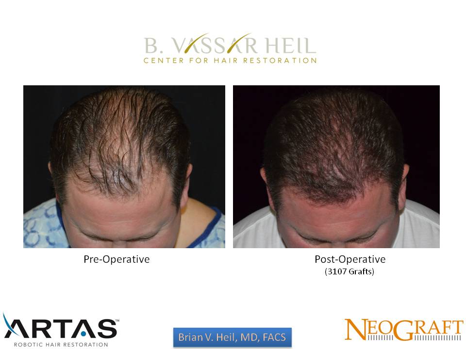 Hair Restoration Before and After | Premier Plastic Surgery