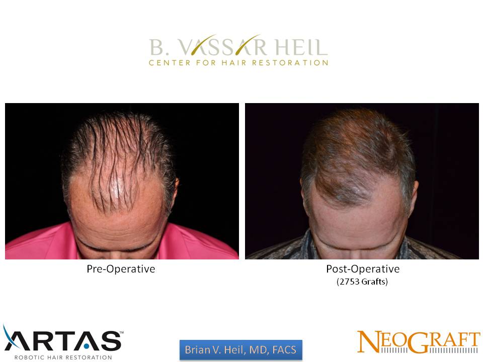 Hair Restoration Before and After | Premier Plastic Surgery