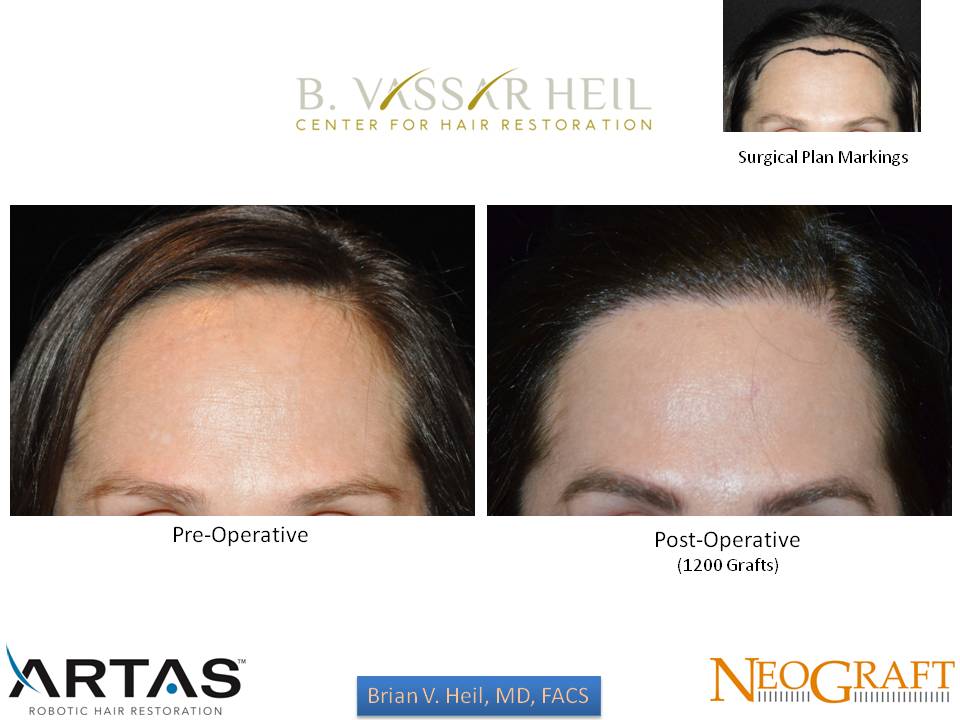 Hair Restoration Before and After | Premier Plastic Surgery