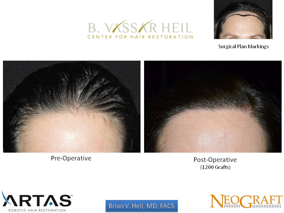 Hair Restoration Before and After | Premier Plastic Surgery