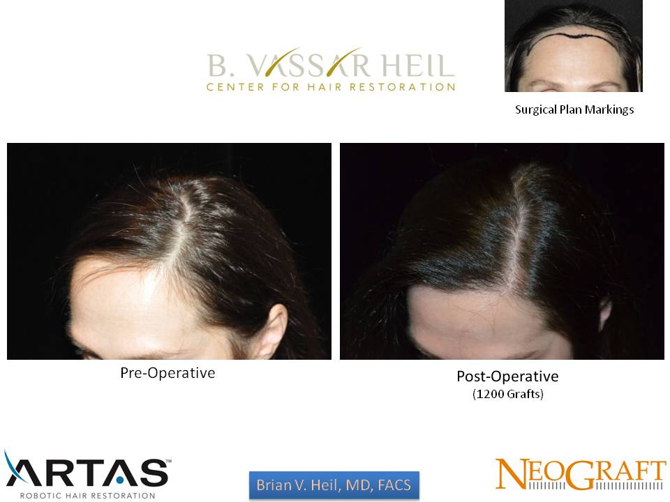 Hair Restoration Before and After | Premier Plastic Surgery