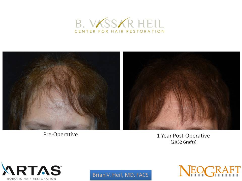 Hair Restoration Before and After | Premier Plastic Surgery