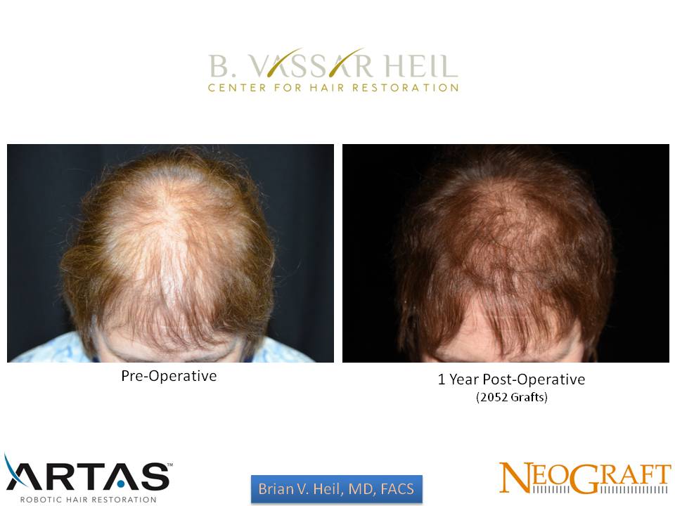 Hair Restoration Before and After | Premier Plastic Surgery