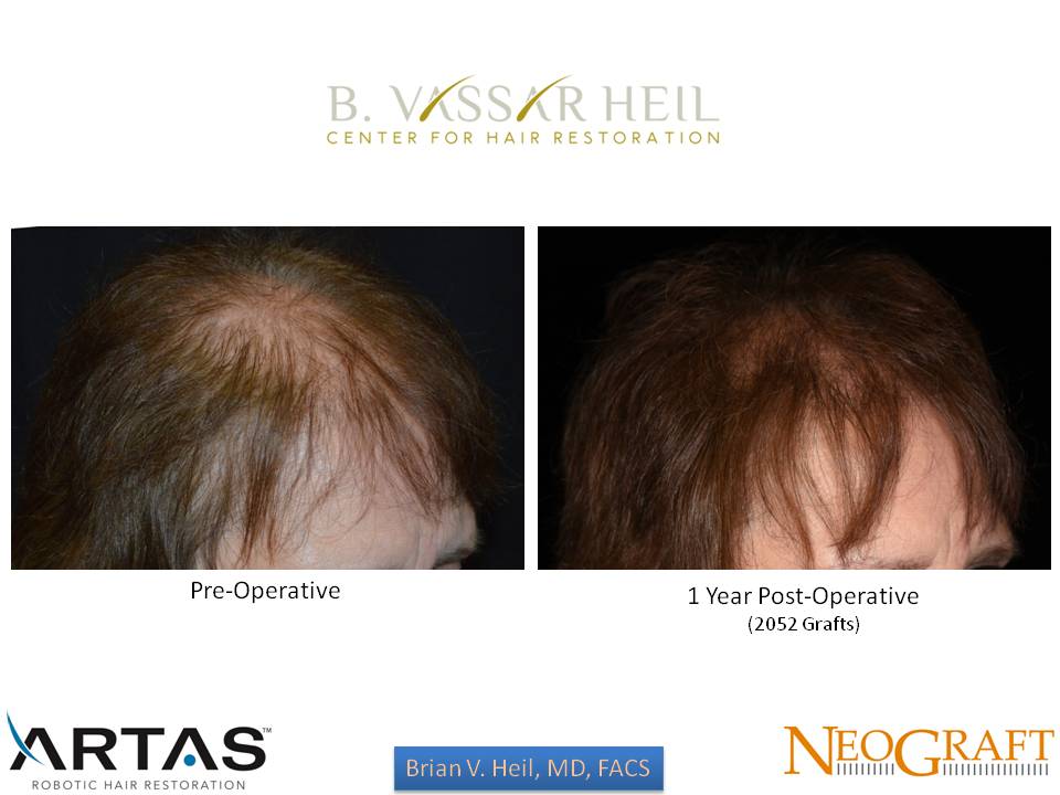 Hair Restoration Before and After | Premier Plastic Surgery