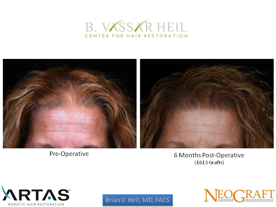 Hair Restoration Before and After | Premier Plastic Surgery