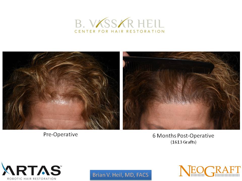 Hair Restoration Before and After | Premier Plastic Surgery