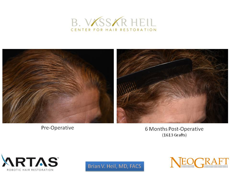 Hair Restoration Before and After | Premier Plastic Surgery