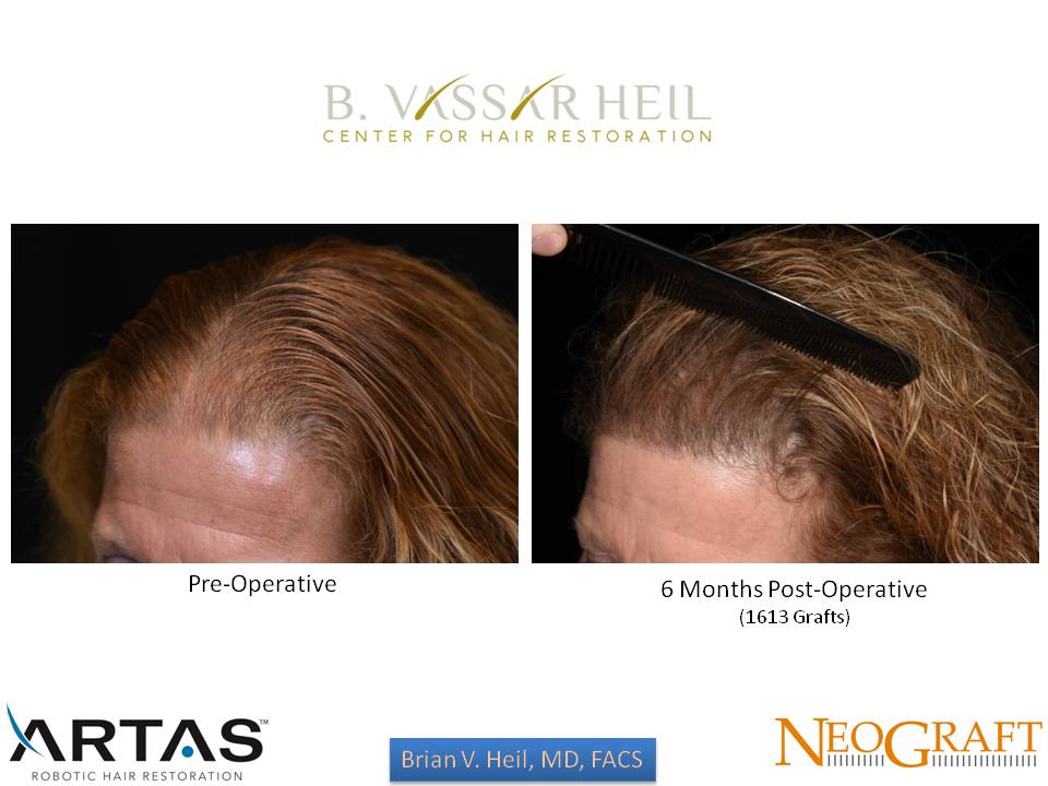 Hair Restoration Before and After | Premier Plastic Surgery