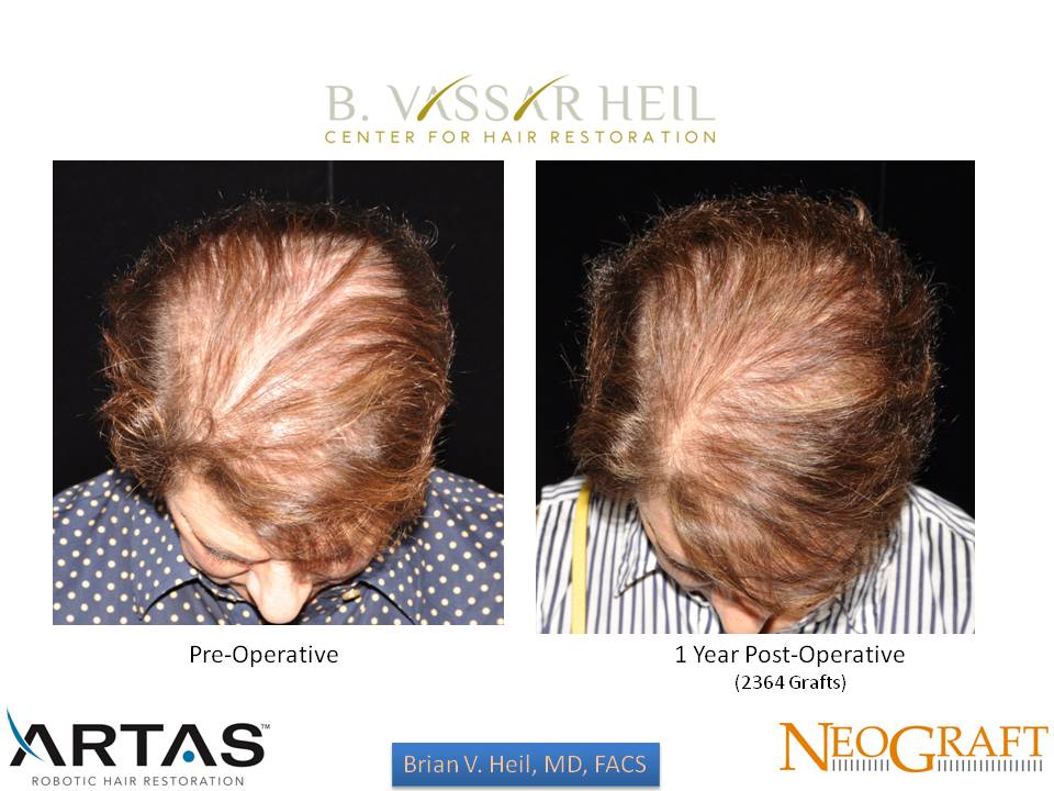 Hair Restoration Before and After | Premier Plastic Surgery