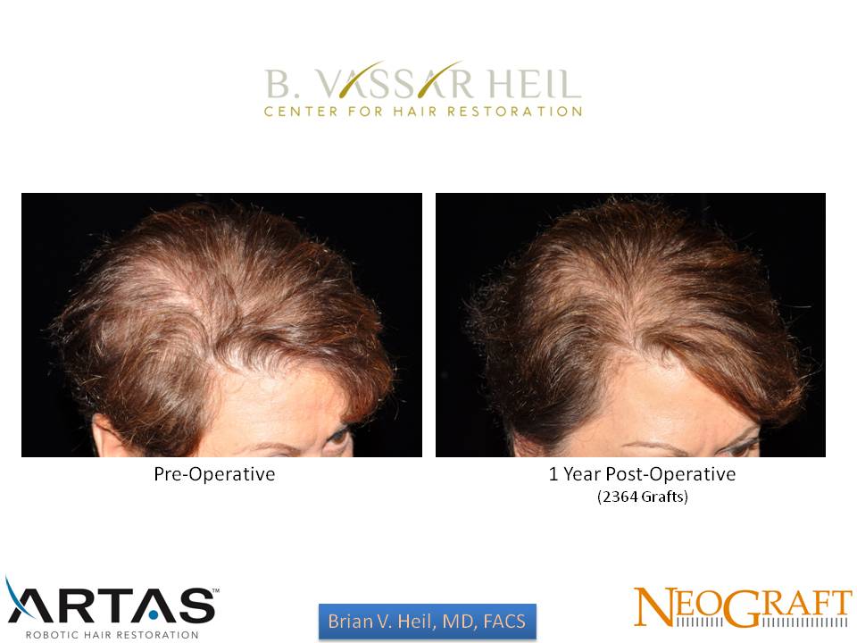 Hair Restoration Before and After | Premier Plastic Surgery