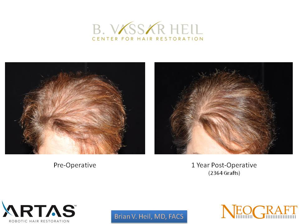 Hair Restoration Before and After | Premier Plastic Surgery