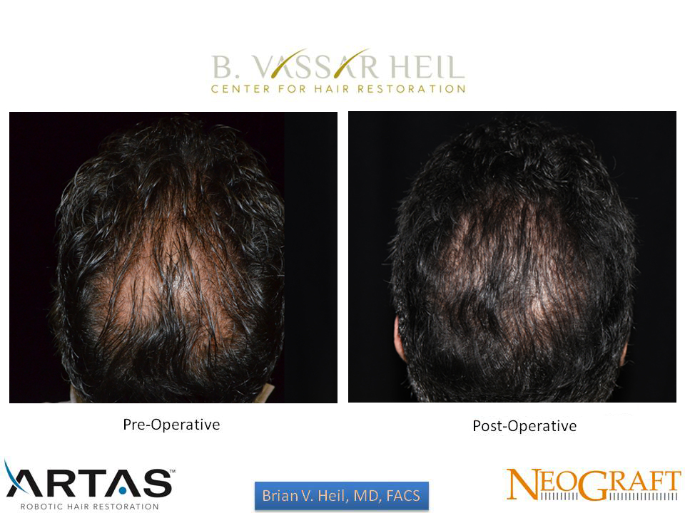 Hair Restoration Before and After | Premier Plastic Surgery