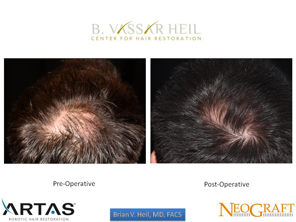 Hair Restoration Before and After | Premier Plastic Surgery