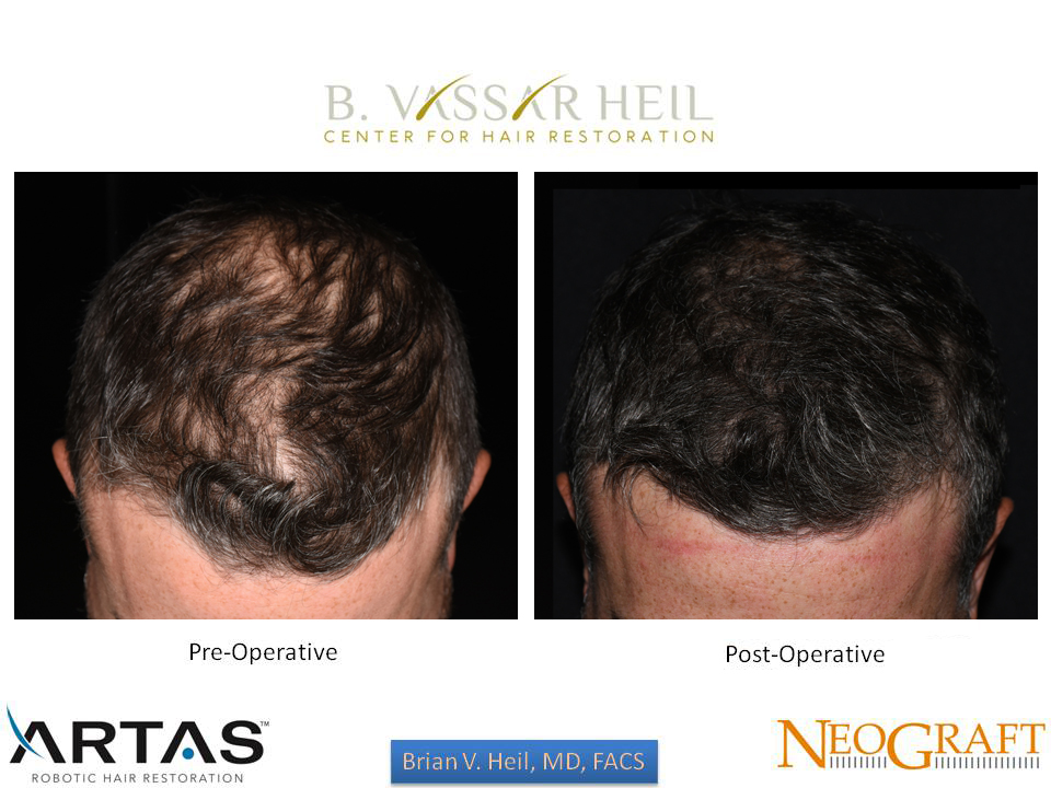 Hair Restoration Before and After | Premier Plastic Surgery