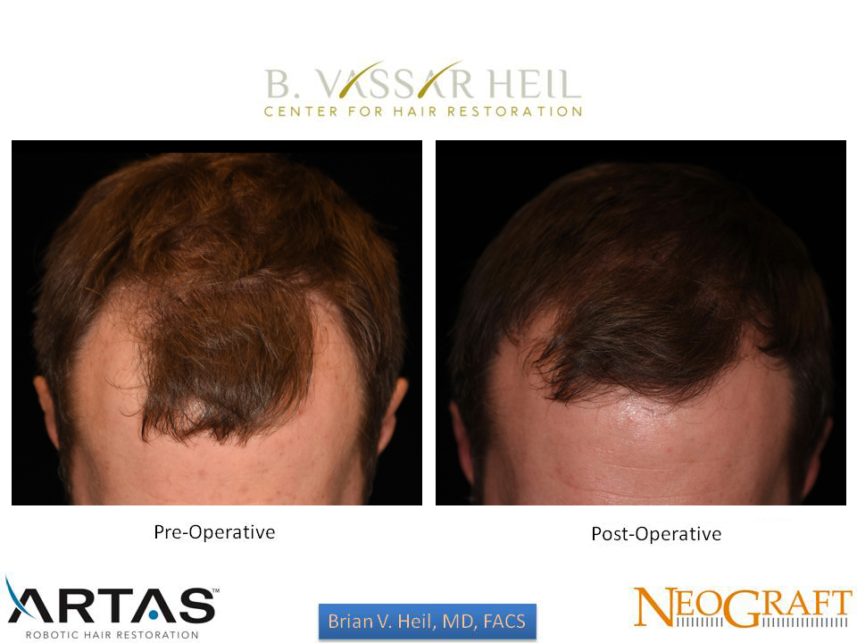 Hair Restoration Before and After | Premier Plastic Surgery