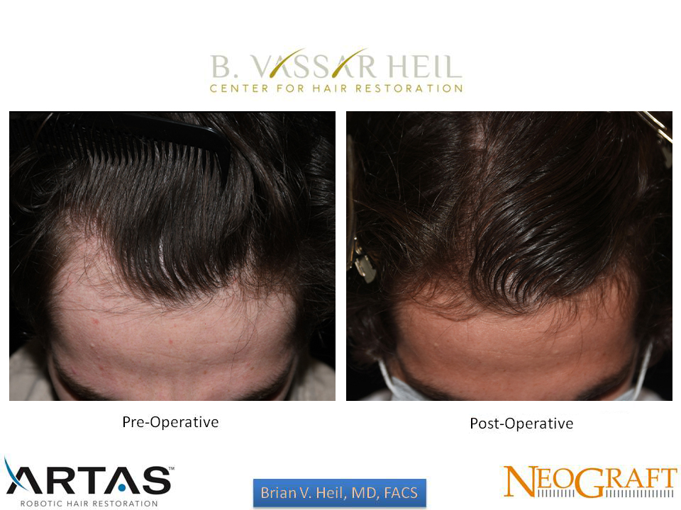 Hair Restoration Before and After | Premier Plastic Surgery