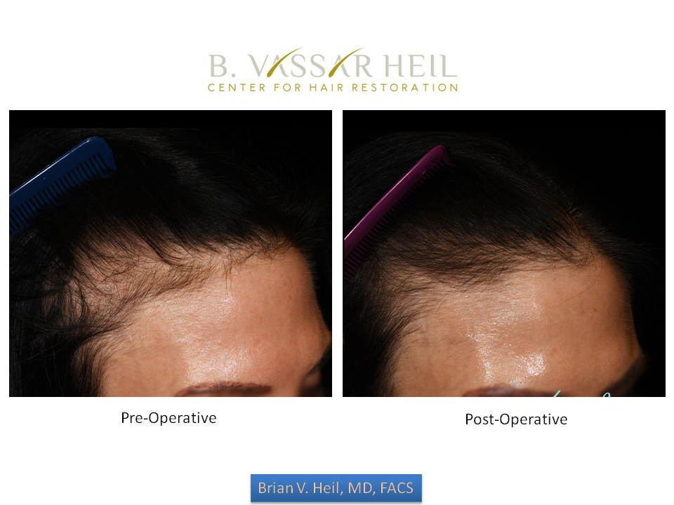 Prp Before and After | Premier Plastic Surgery