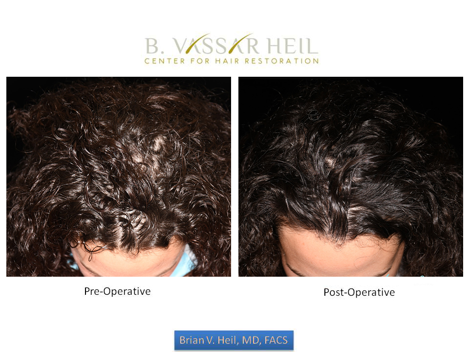 Prp Before and After | Premier Plastic Surgery