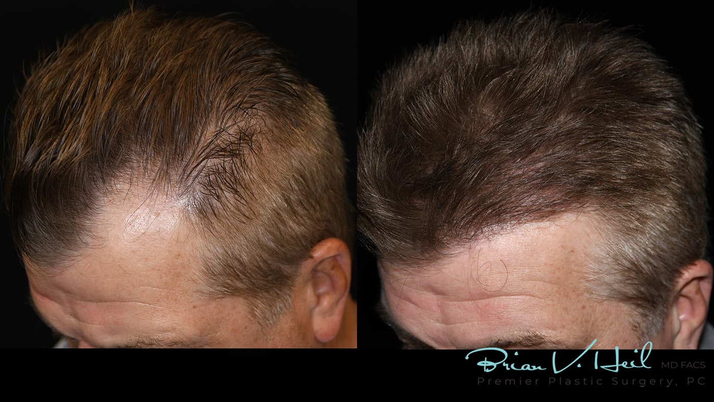 Hair Transplant on Local Celebrity Phil Bourque | Hair Restoration for Men  in PA